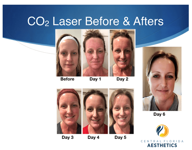 CO2 Laser Recovery - What to expect after the treatment 