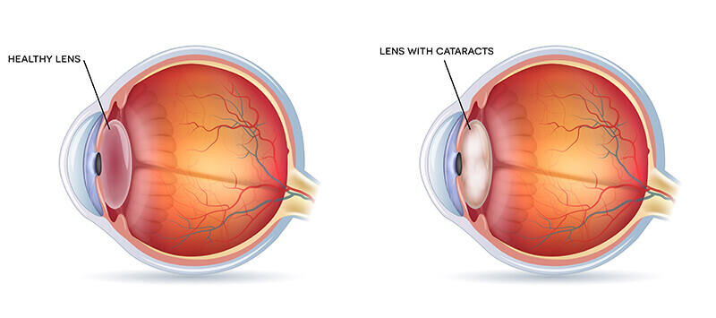 A Chart Showing a Healthy Eye, Compared to One With a Cataract