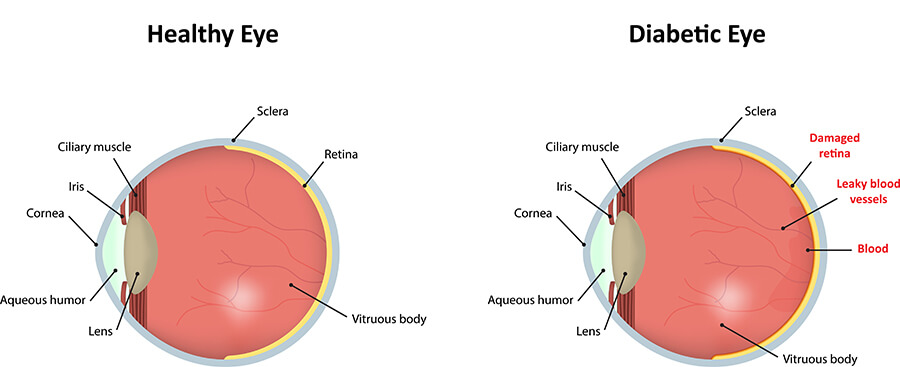 Chart showing a healthy eye compared to one that has diabetic retinopathy