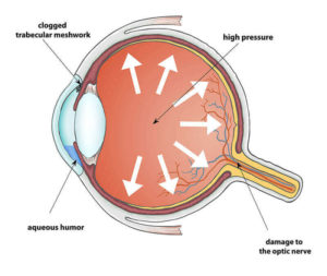 Chart Showing What Glaucoma Does in the Eye
