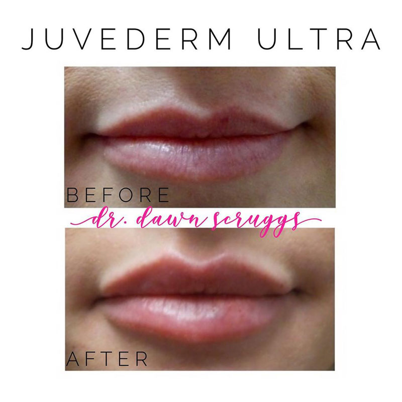 Juvederm Ultra Before & After