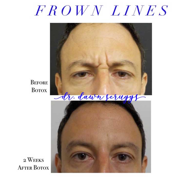 BOTOX Frown Lines
