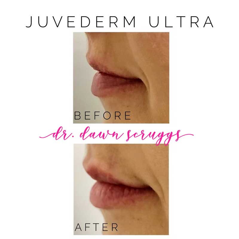 Juvederm Ultra Before & After