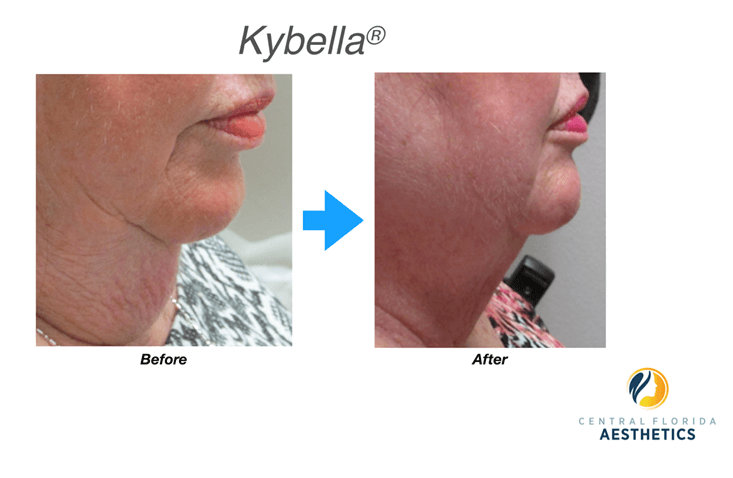 Kybella Before and After